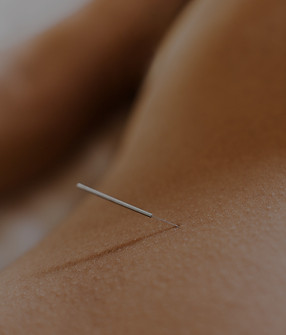 Close up of dry needling