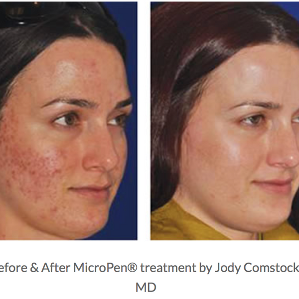 Eclipse Micropen Elite | LE HEALING CLINC