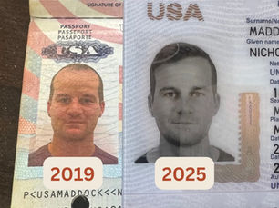 My Turkish Hair Transplant Experience