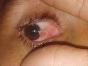 Una sanrafaelina perdió la mitad de su visión y pide ayuda para operarse