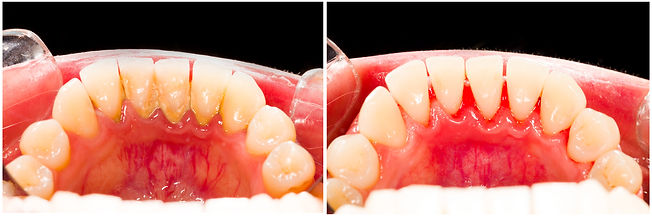 Dental Exam and Cleaning Plaque Removal