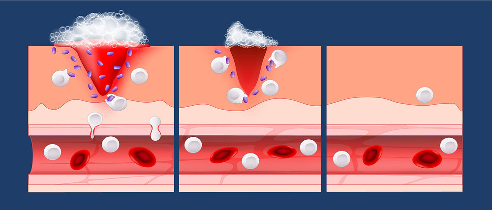 Nitric Oxide and Foam: The Breakthrough for Wound Healing