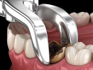 tooth-extraction-healing.jpg