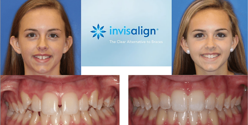 NJ Invisalign