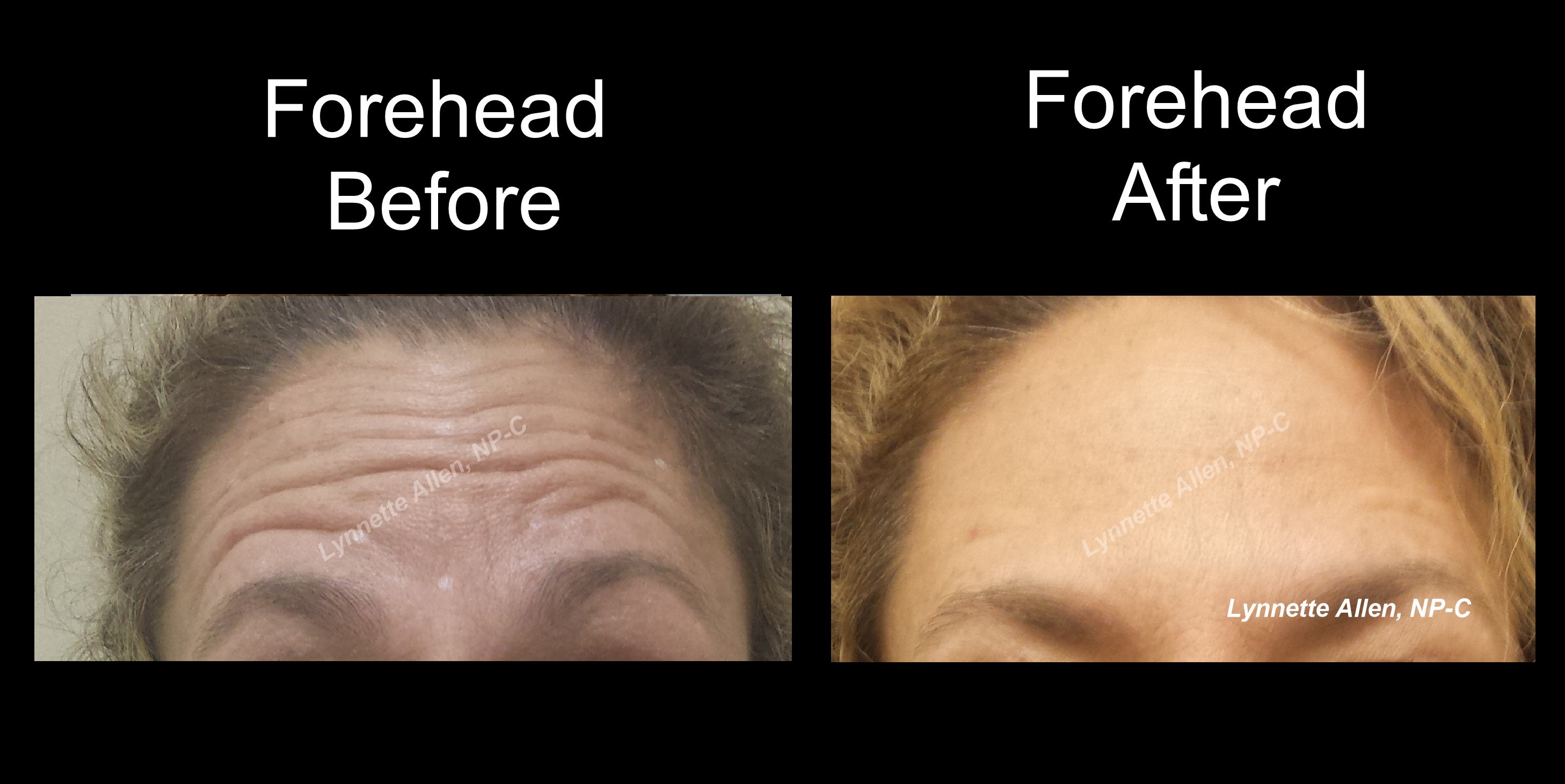 Faces Refreshed Before & Afters Botox, Fillers, PDO Threads