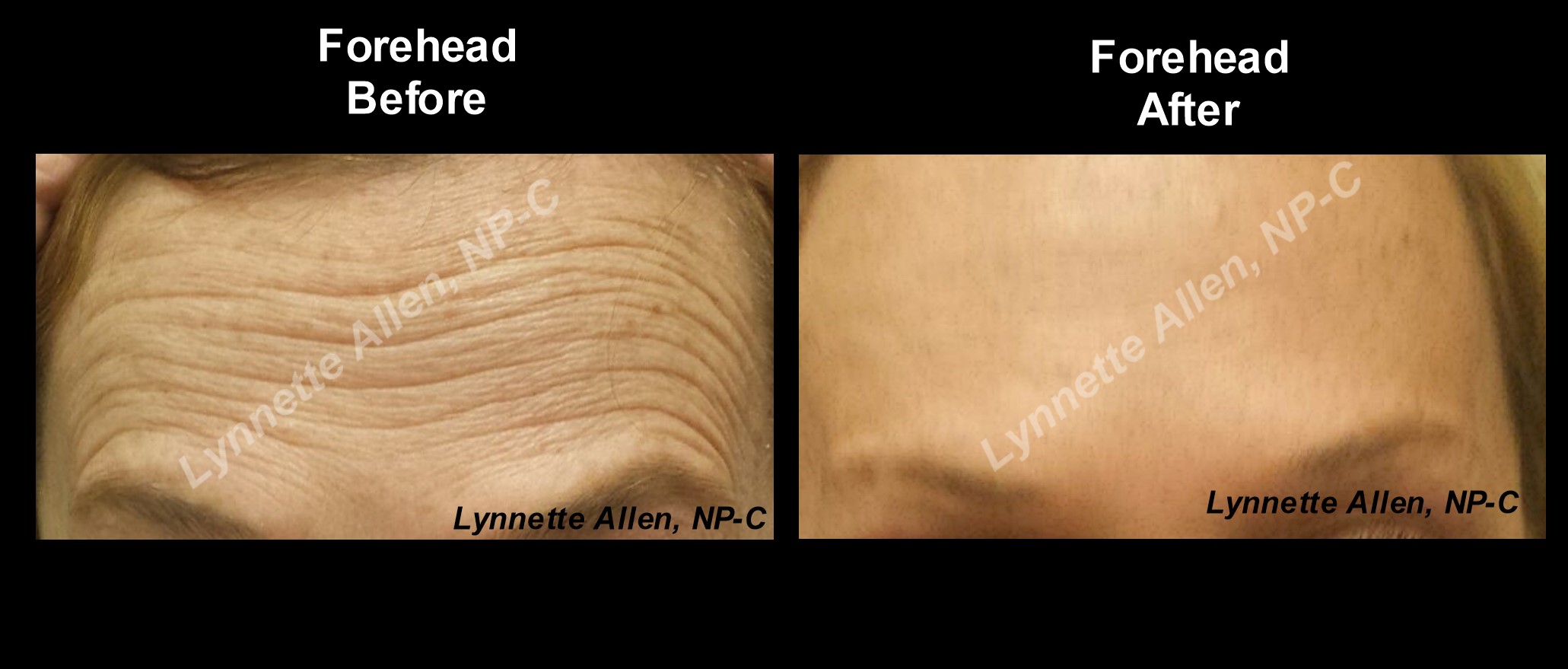 Faces Refreshed Before & Afters Botox, Fillers, PDO Threads