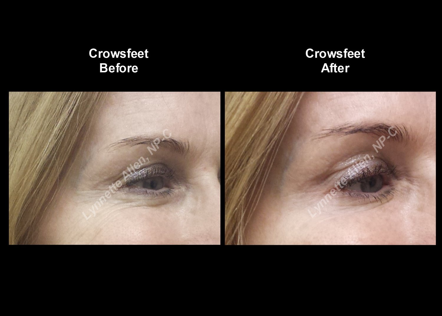 Faces Refreshed Before & Afters Botox, Fillers, PDO Threads