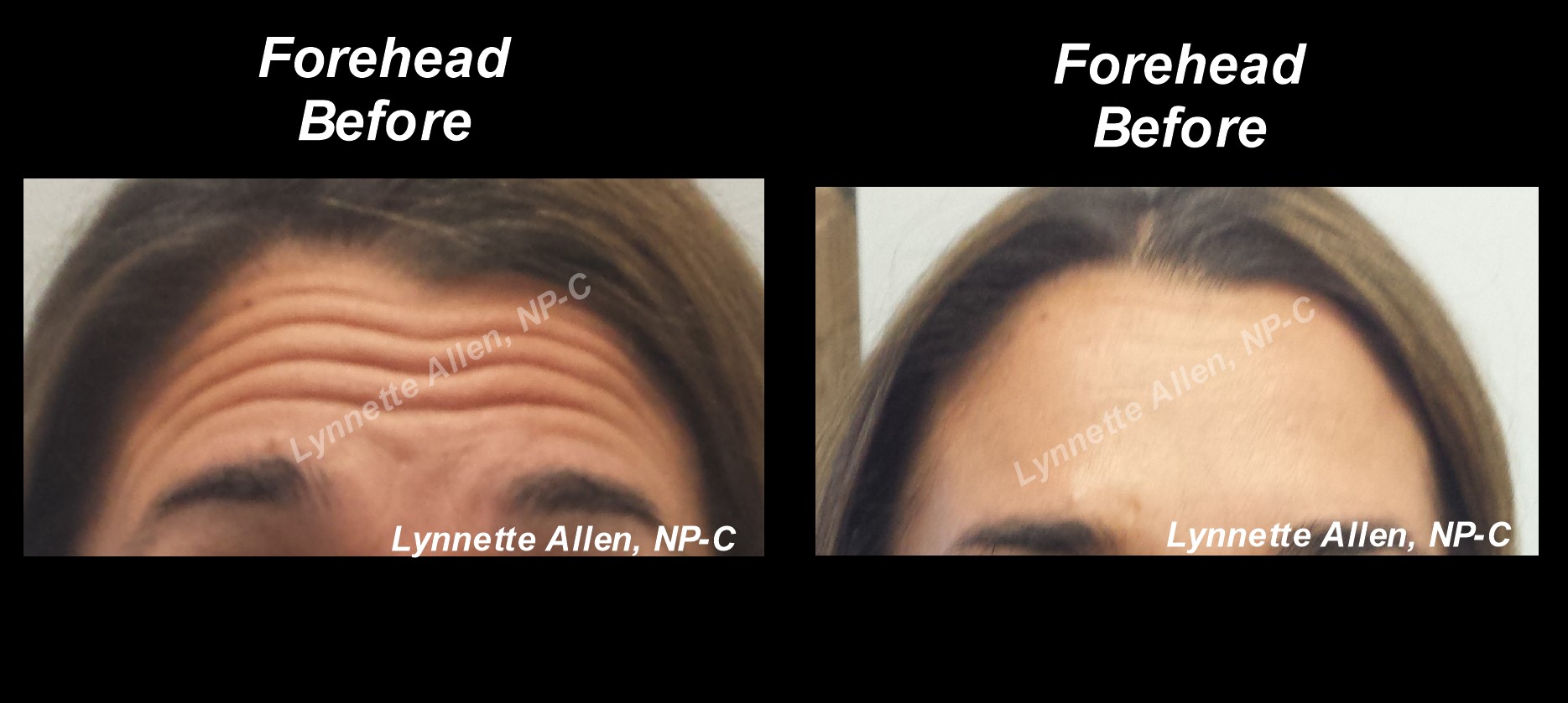Faces Refreshed Before & Afters Botox, Fillers, PDO Threads