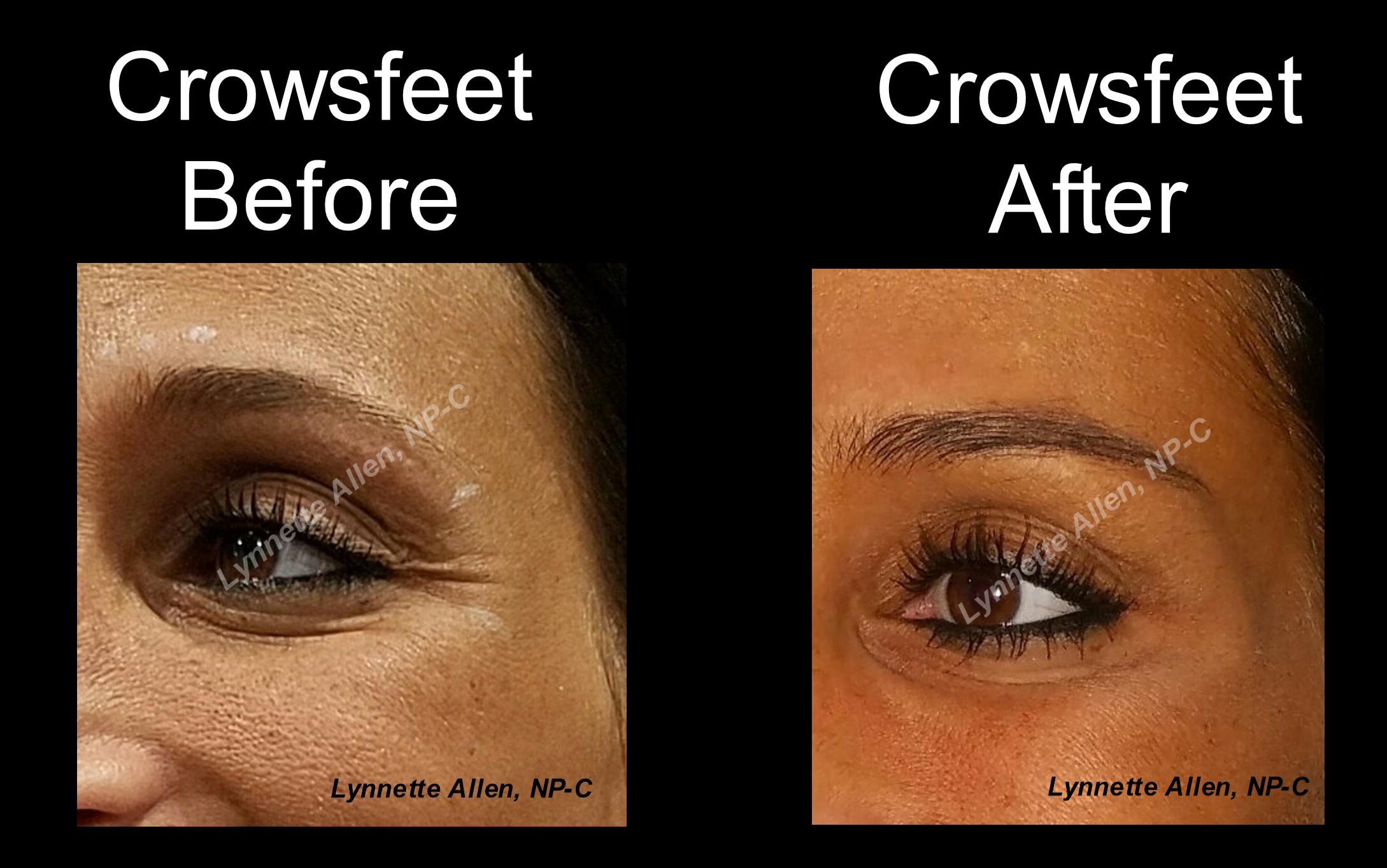 Faces Refreshed Before & Afters Botox, Fillers, PDO Threads