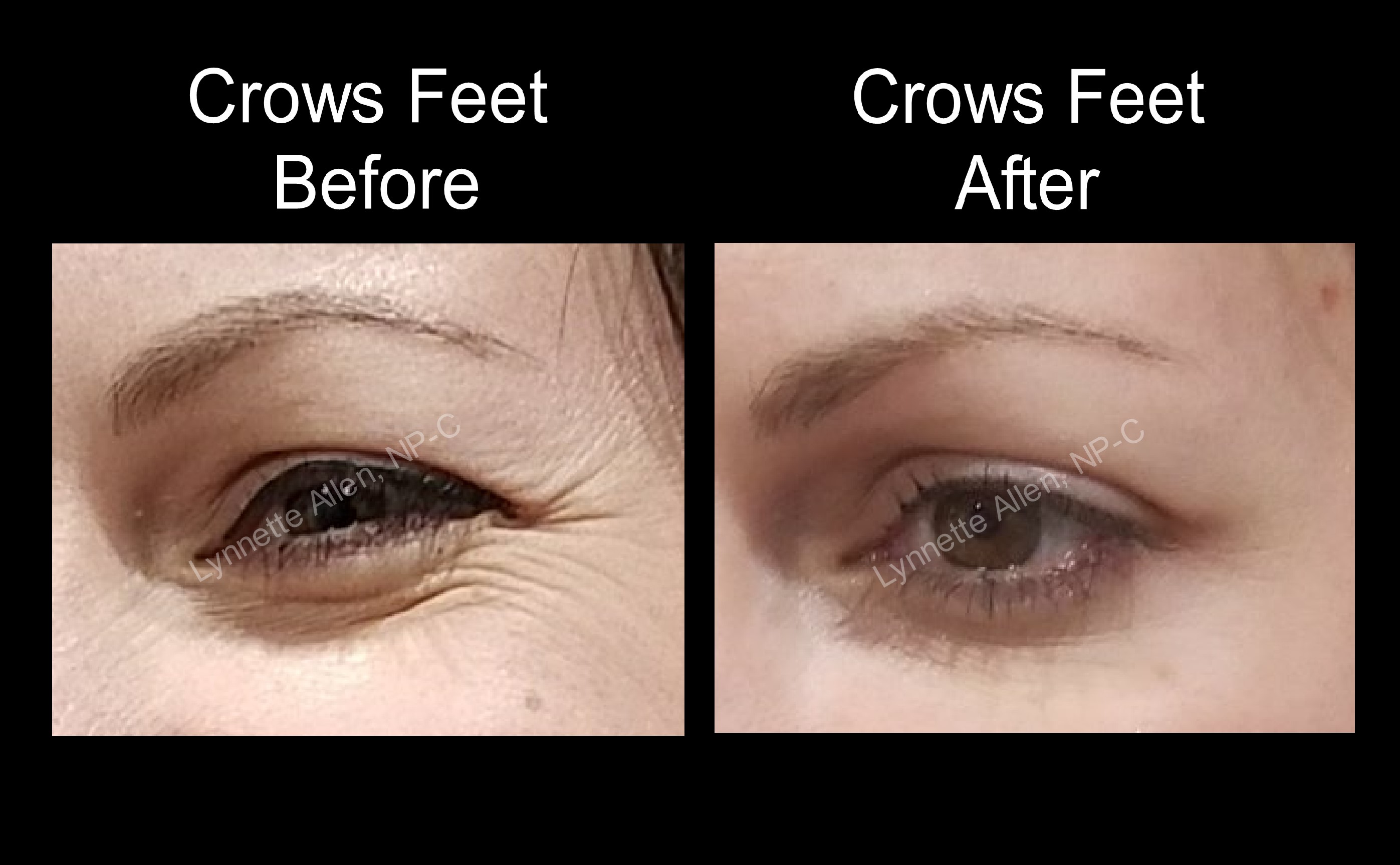 Faces Refreshed Before & Afters Botox, Fillers, PDO Threads