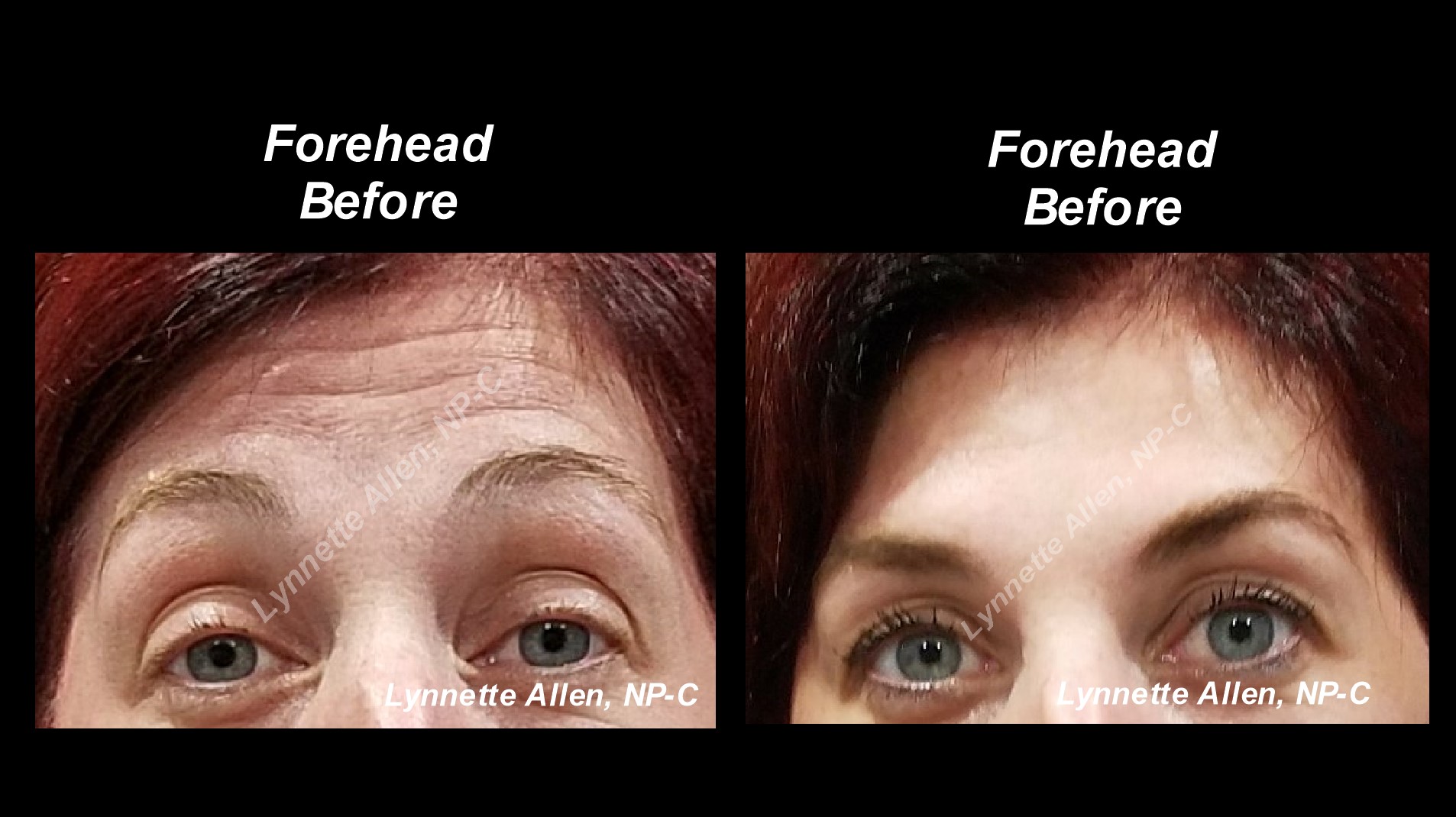 Faces Refreshed Before & Afters Botox, Fillers, PDO Threads