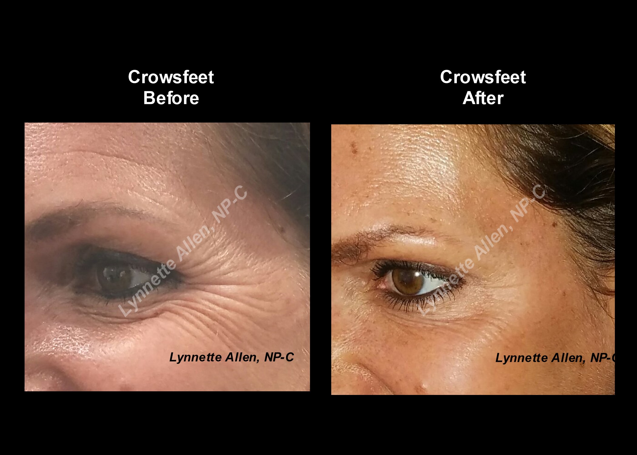 Faces Refreshed Before & Afters Botox, Fillers, PDO Threads