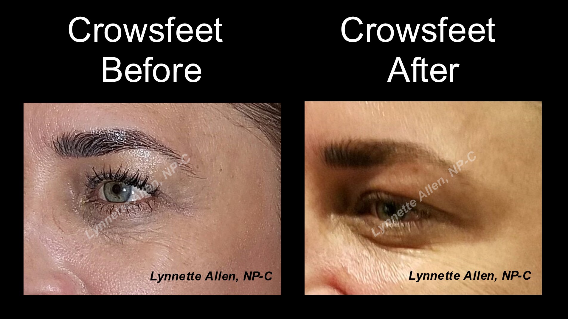 Faces Refreshed Before & Afters Botox, Fillers, PDO Threads