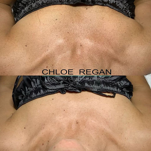 SkinPen microneedling before and after results for pigmentation and sun damage – Chloe Regan Cosmetic Clinic Noosa, Sunshine Coast.