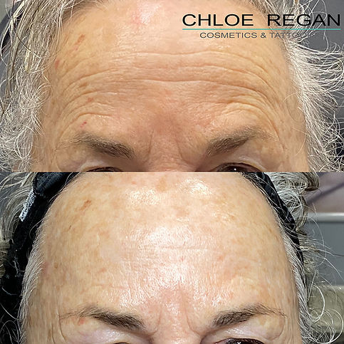 Microneedling with SkinPen before and after photo showing frown line reduction at Chloe Regan Cosmetic Clinic in Noosa, Sunshine Coast.