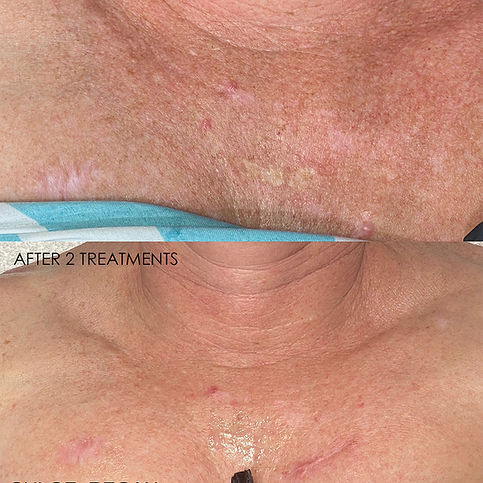 Before and after scar reduction following 2 SkinPen skin needling treatments at Chloe Regan Cosmetic Clinic – Noosa, Sunshine Coast.