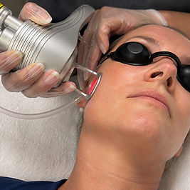 CO2 fractional laser treatment being performed on the face for sun damage and uneven skin tone at Chloe Regan Cosmetic Clinic in Noosa, sunshine coast