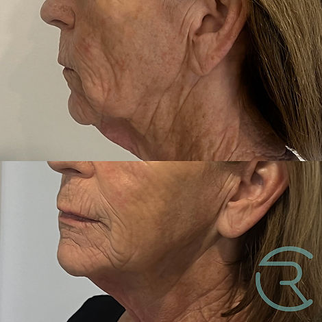 12-week before and after of non-surgical lower face lift using Ultraformer MPT HIFU, showing lifted jawline and defined contouring – Noosa, Sunshine Coast.