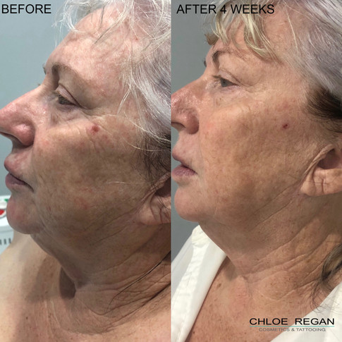 HIFU Before and After 4 weeks