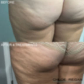 Client 6-1 alpha shape pro body contouri