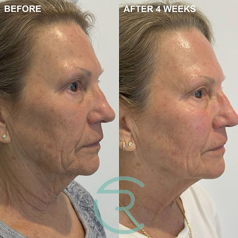 Before and after SKN Peel CO2 Fractional Laser treatment for skin rejuvenation in Noosa, Sunshine Coast