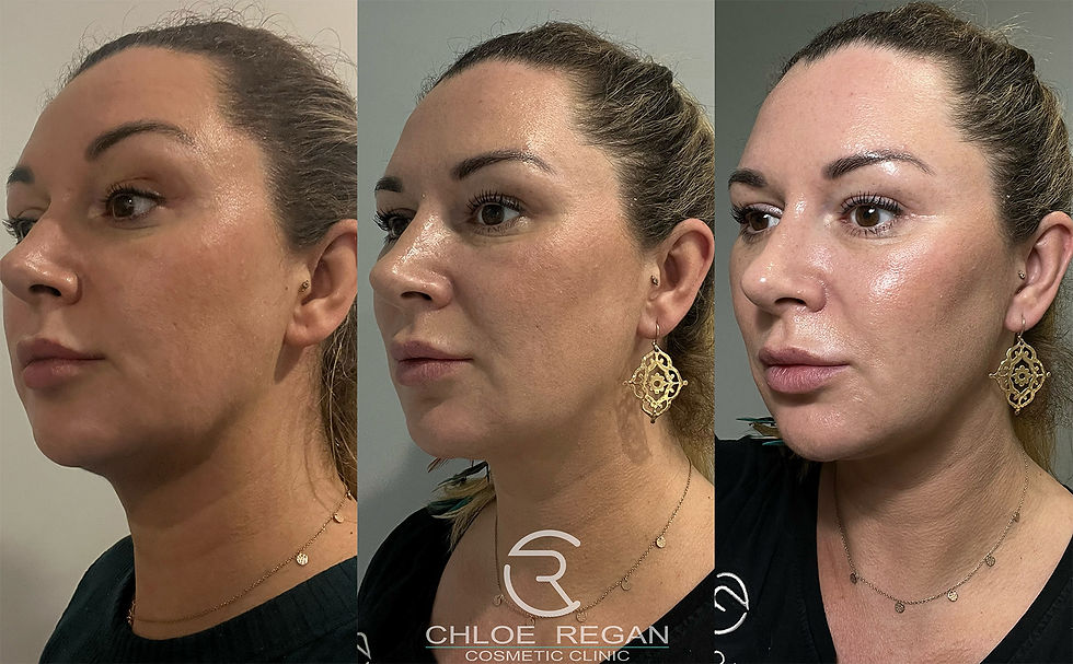 Ultraformer MPT HIFU before and after results showing progressive facelift improvement at 4 and 12 weeks post-treatment in Noosa, Sunshine Coast.