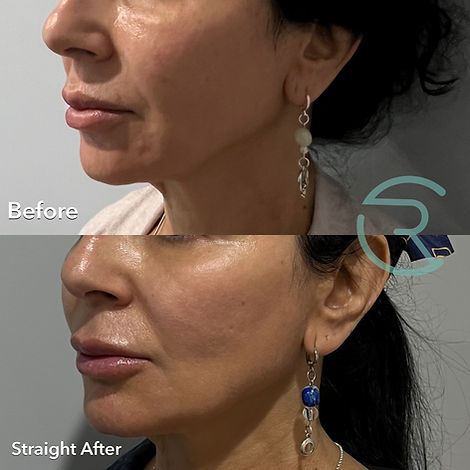 Ultraformer MPT before and after HIFU image showing improved jowls, facial lifting, contouring, and definition at Chloe Regan Cosmetic Clinic, Noosa