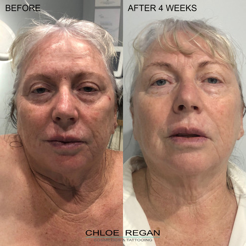 HIFU Before and After 4 weeks