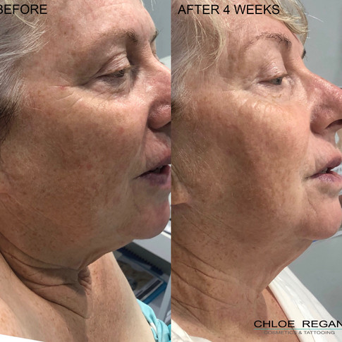HIFU Before and After 4 weeks