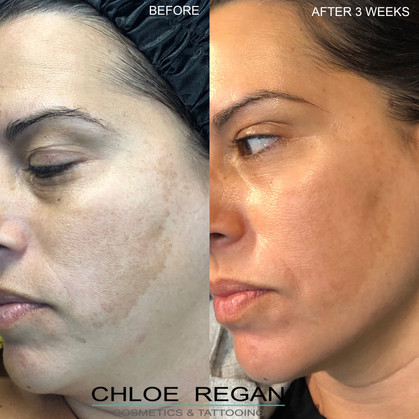 Cosmelan Peel, depigmentation treatment Before and 21 days After