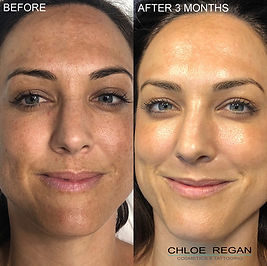 Before and after Cosmelan pigmentation treatment showing improvement in facial pigmentation and uneven skin tone after three months