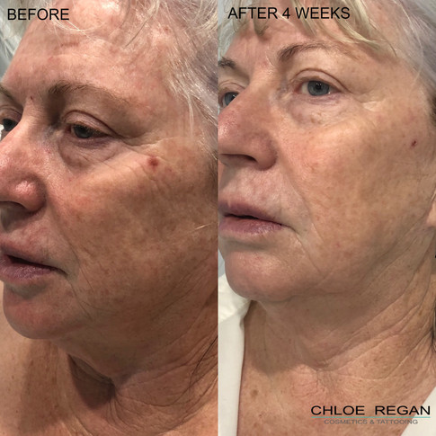 HIFU Before and After 4 weeks