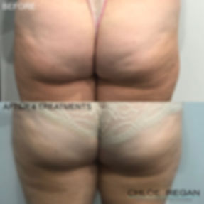 Client 6-2 alpha shape pro body contouri