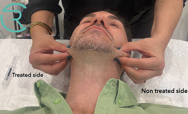 Ultraformer MPT HIFU collagen stimulation and skin tightening result at Chloe Regan Cosmetic Clinic in Noosa, showing half-face treated client with visible lifting and definition