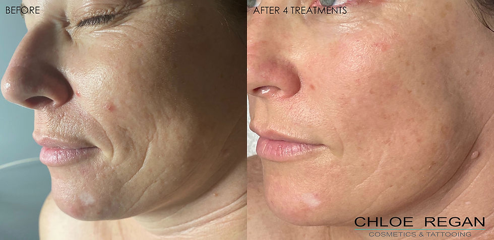 Microneedling before and after photo showing results after 4 treatments at Chloe Regan Cosmetic Clinic – Noosa, Sunshine Coast.