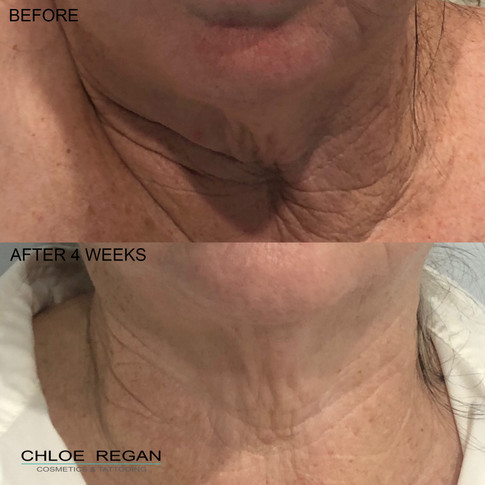 HIFU Before and After 4 weeks