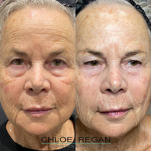 Before and after results of wrinkle reduction using microneedling SkinPen treatment at Chloe Regan Cosmetic Clinic Noosa, Sunshine Coast.