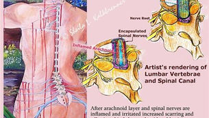 Arachnoiditis & FSM (Frequency Specific Microcurrent) Everything You Need To Know