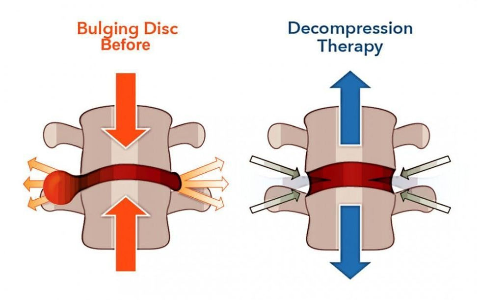 Common Conditions Treated with Spinal Decompression (Herniated Discs, Sciatica & More)