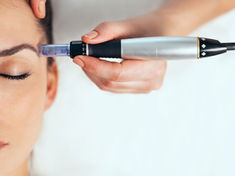 Is Microneedling Good for your Skin?