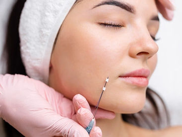 PDO Thread Lift In Redlands
