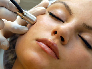 Microdermabrasion in Redlands