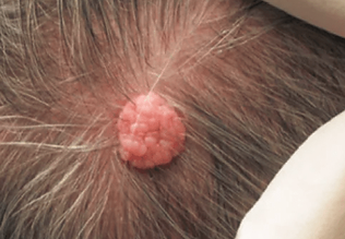 Skin-lesion-scalp-before-e1541812671809-460x458.png