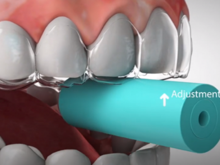 What are refinement aligners?