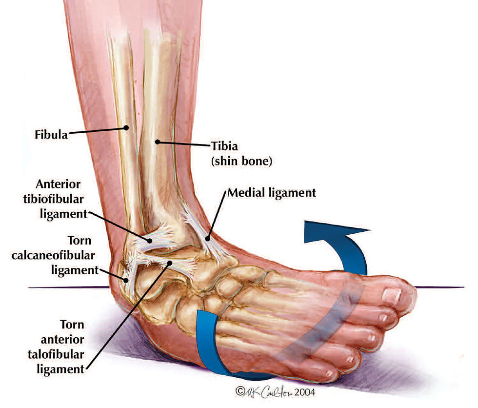 Ankle Sprains: Effective Treatments to Get You Back on Your Feet
