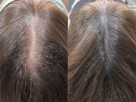 Scalp Micropigmentation: A Modern Non-Surgical Solution for Hair Loss