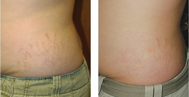 Inkless Stretch Mark Revision
