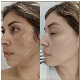 SQT Bio Microneedling before and after