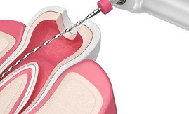 ENDODONCIA MECANIZADA.jpg