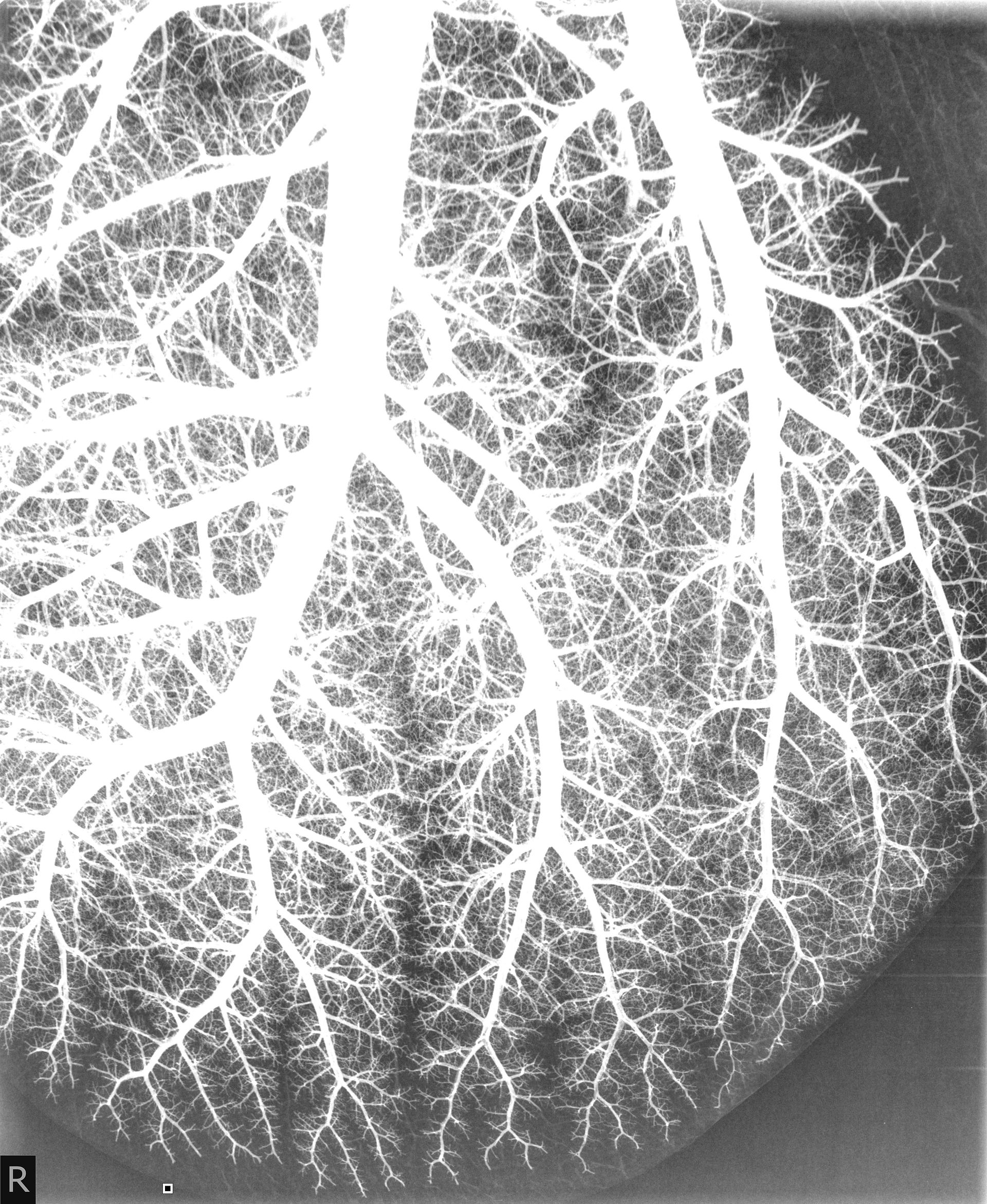 Angiogram of Pulmonary Arteries